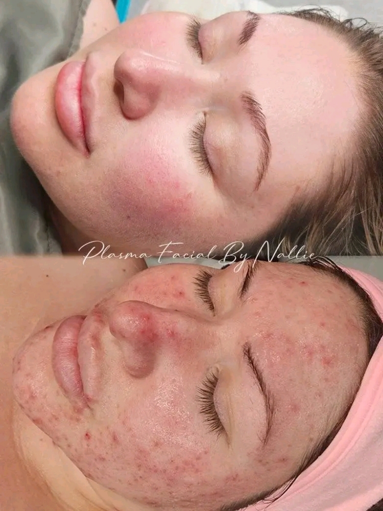 teenPLASMA