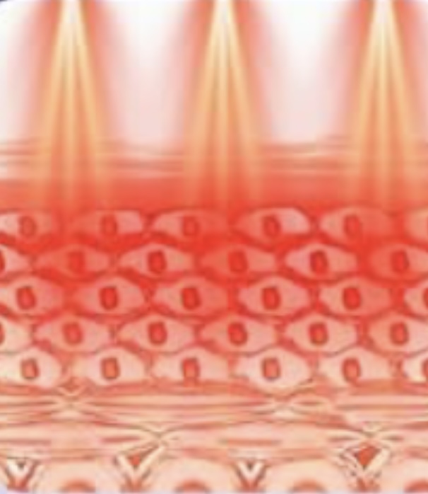 Laser Lipolysis