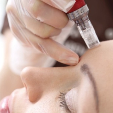 Microneedling/Collagen Induction at Blue Lotus Spa in Fall River, MA