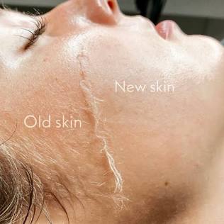 Dermaplane Facial