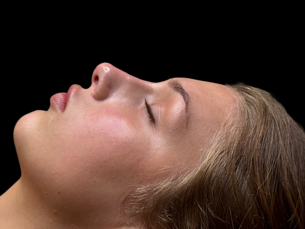 Non-Surgical Rhinoplasty at Al’Aura Aesthetics in Denver, CO