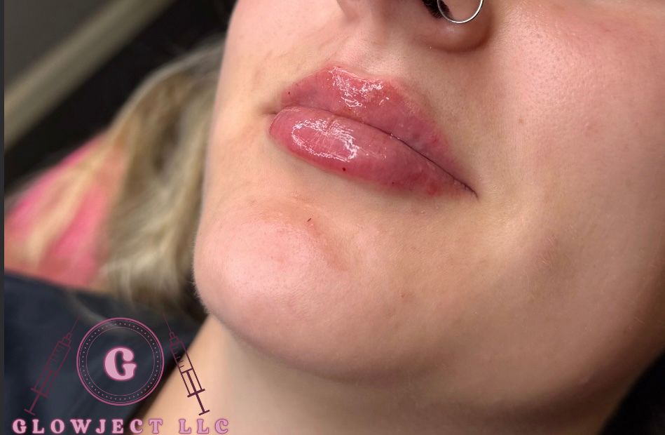 1/2 Syringe Of Lip Filler