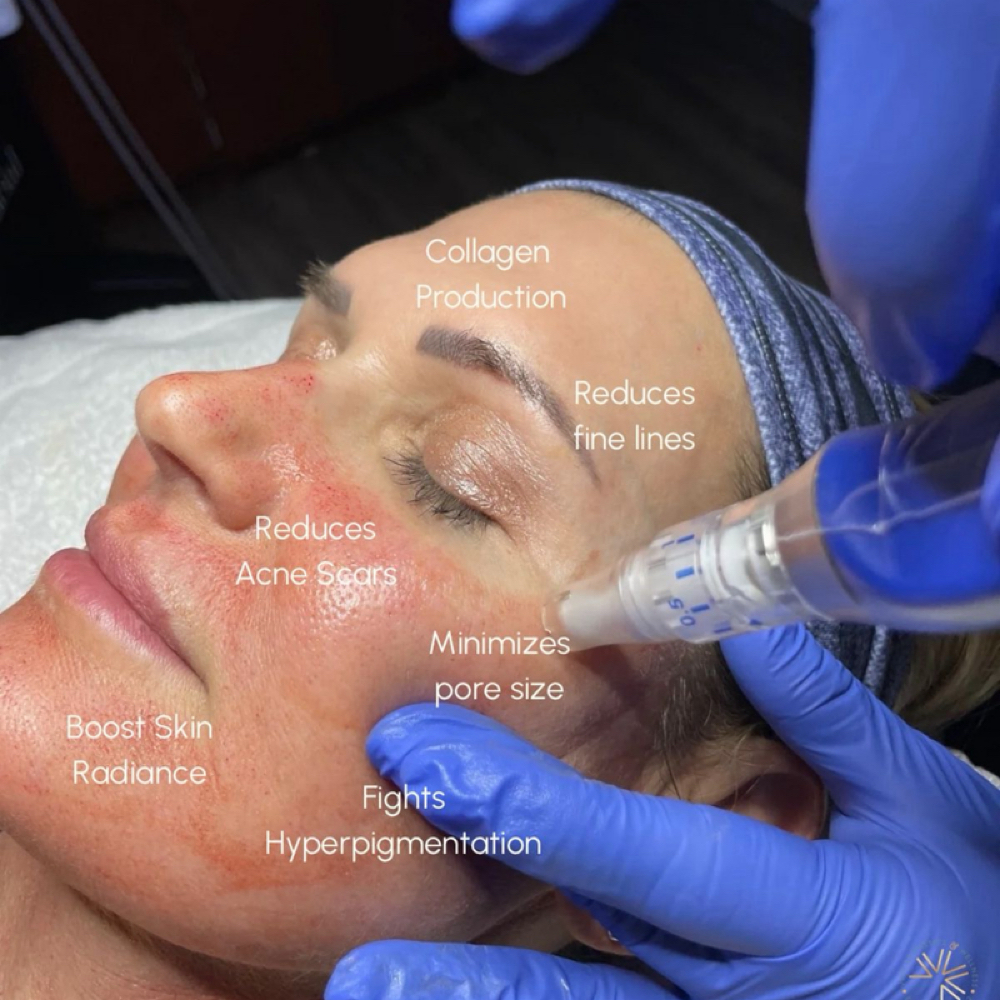 Microneedling Skin Reboot at Babe on E Esthetics in Sanford, NC