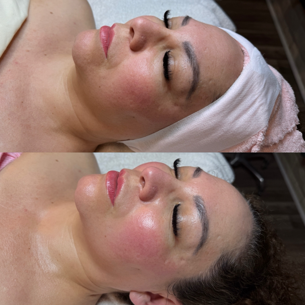 Express Dermaplane at Chiq Beauty in Salinas, CA