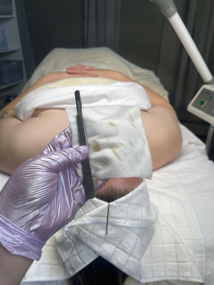 Dermaplanning Add On