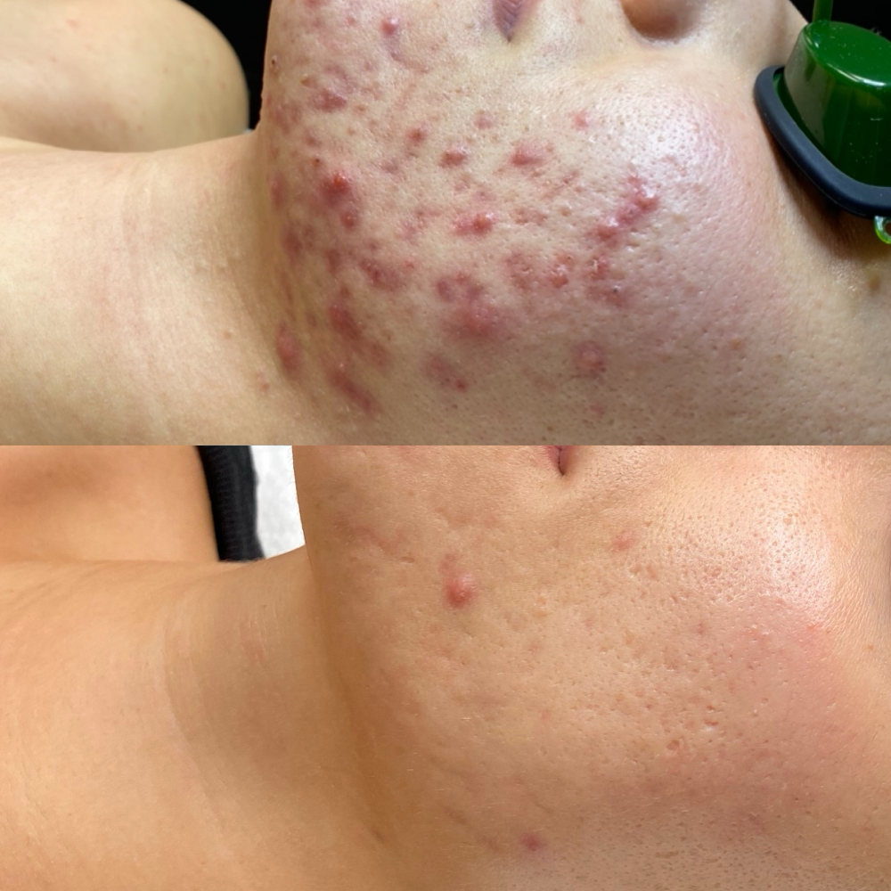 Acne Treatment