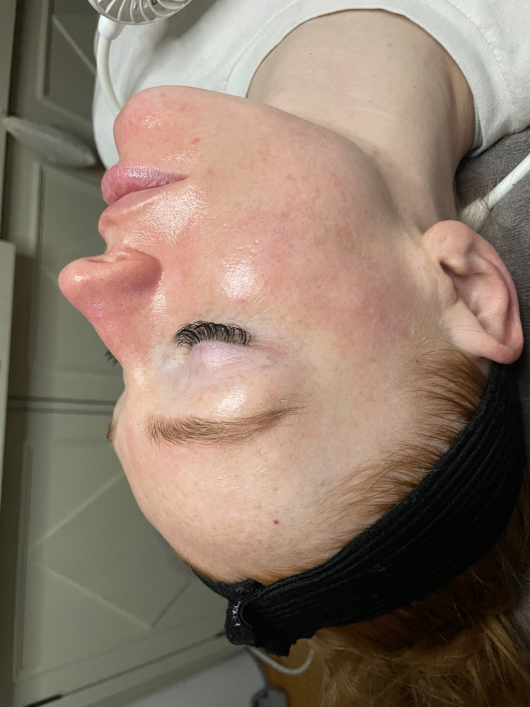 Chemical Peel
