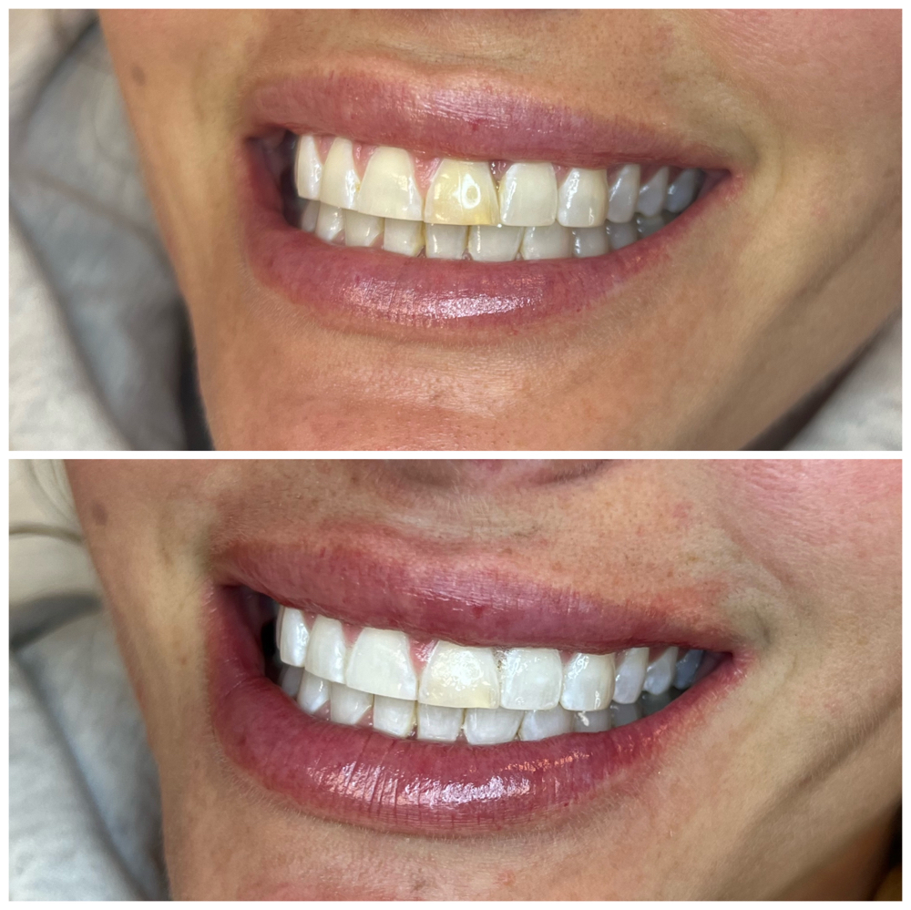 Luxury Teeth Whitening