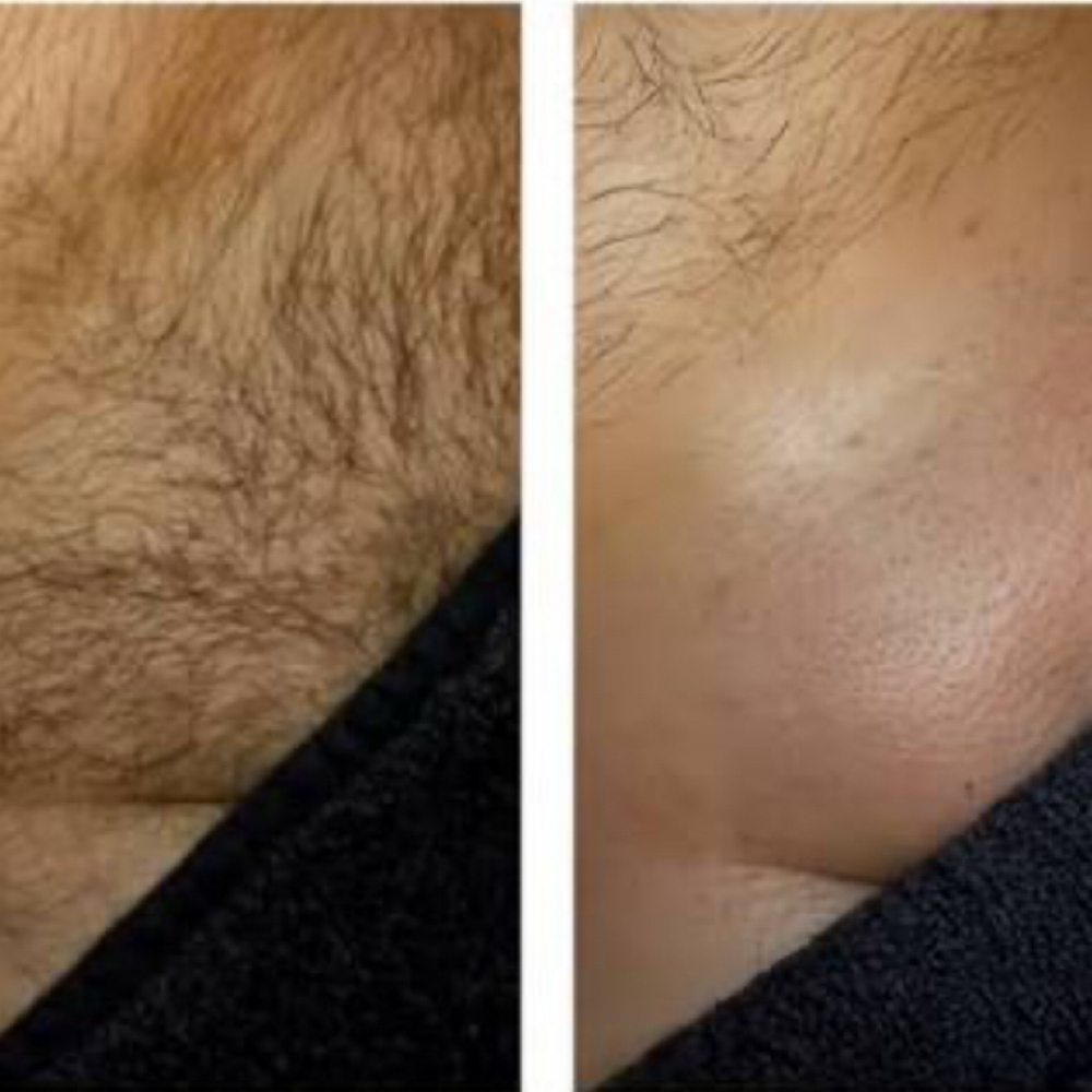 Manzilian at Royal Esthetics in Lubbock, TX