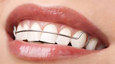Teeth Gap Correction-Retainer Ortho at BG Cosmetic in Inglewood, CA