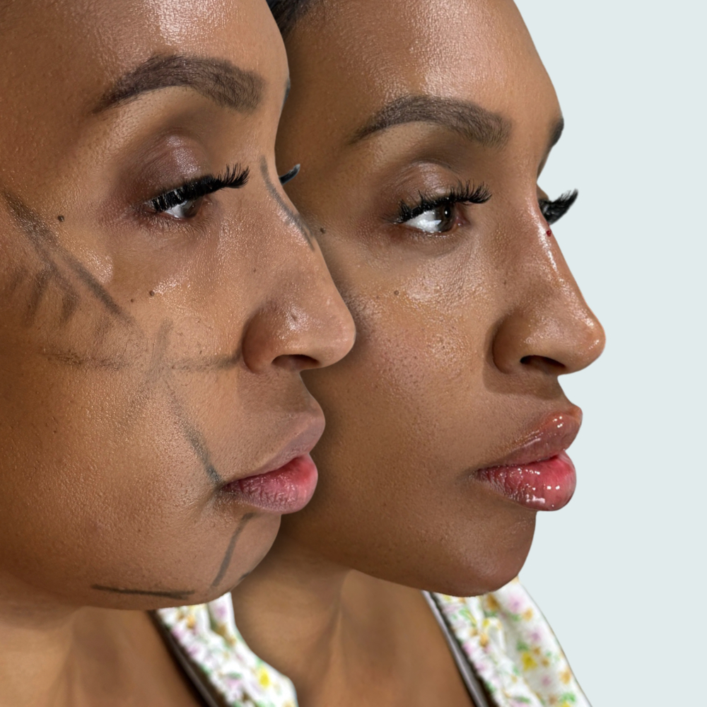 NON SURGICAL RHINOPLASTY at Klashed HTX in Houston, TX