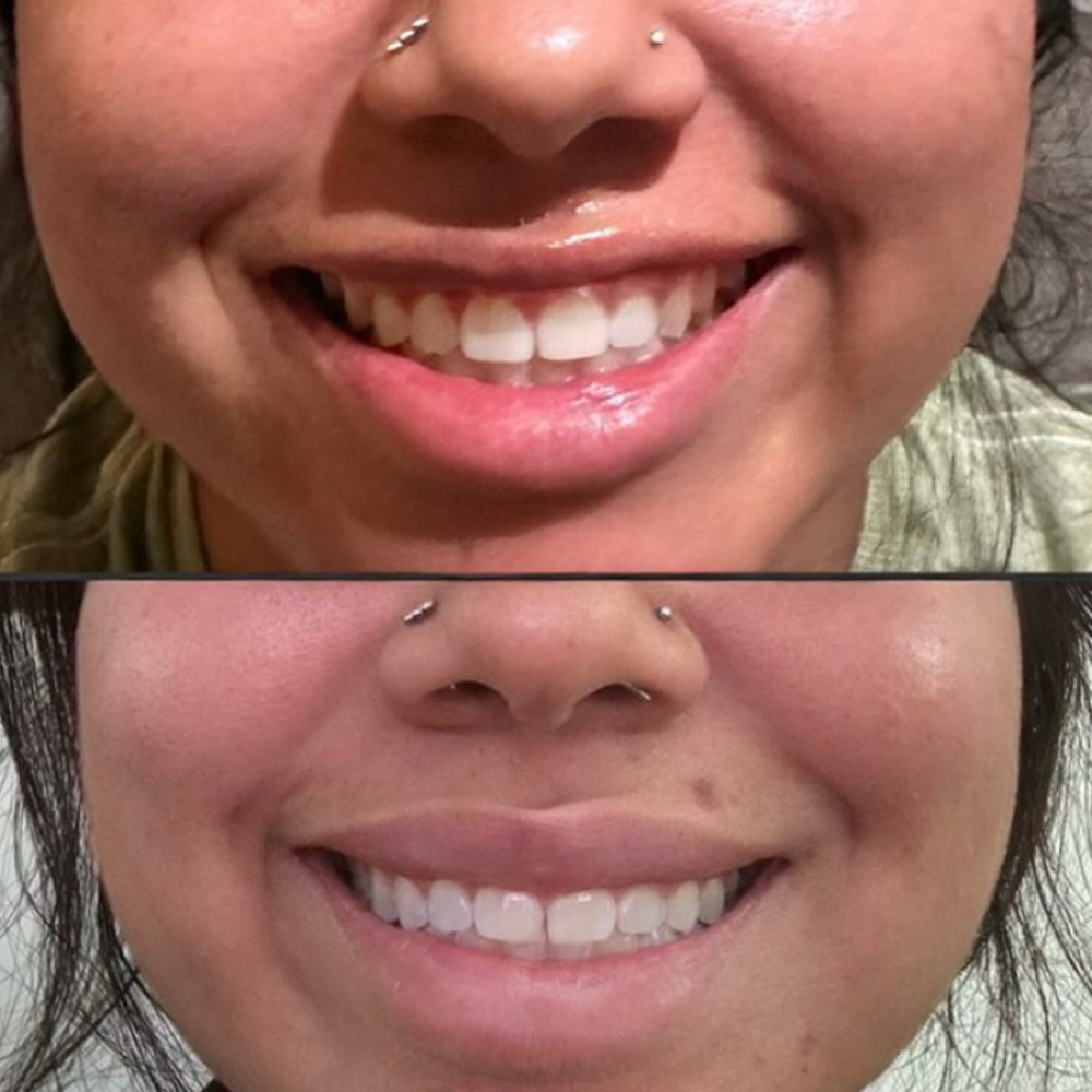 Lip Flip at BlackBird Aesthetics in Fort Worth, TX