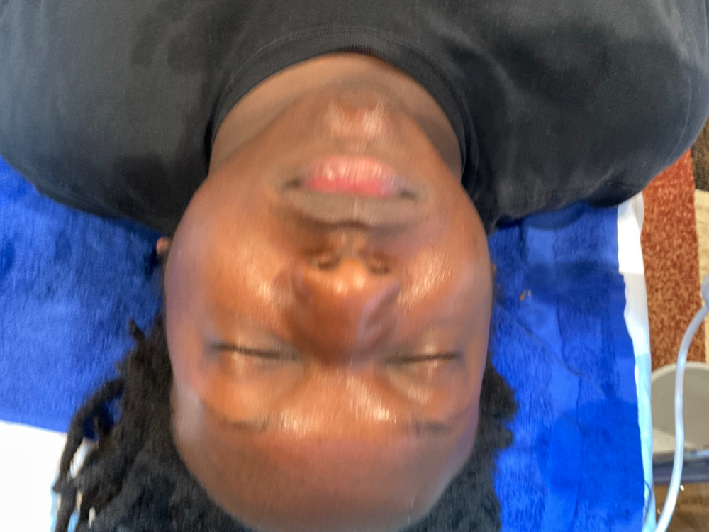 Chemical Peel