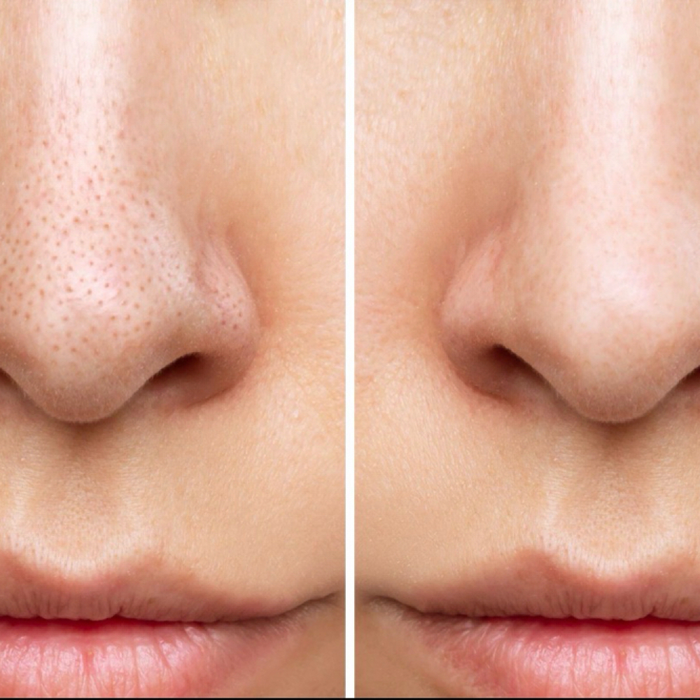 Glycolic50 at Alchemy Health Aesthetic Beauty LLC in Indianapolis, IN