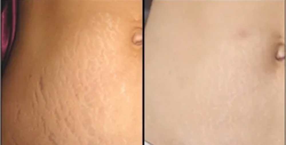 Strechmarks Removal with CO2 Laser