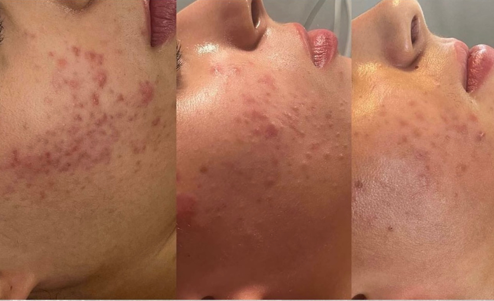 Acne Bootcamp