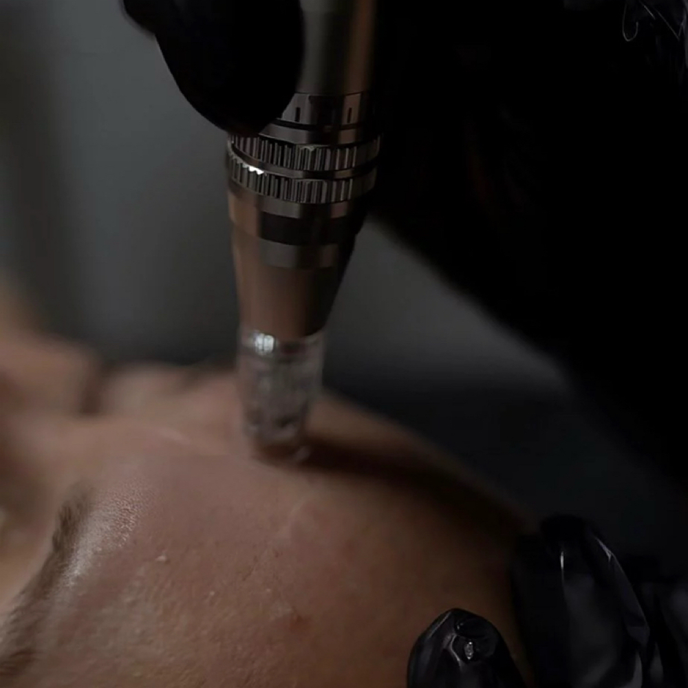 Nano Needling + Hyaluronic Acid at Dania's Dominican Beauty Salon in Hicksville, NY