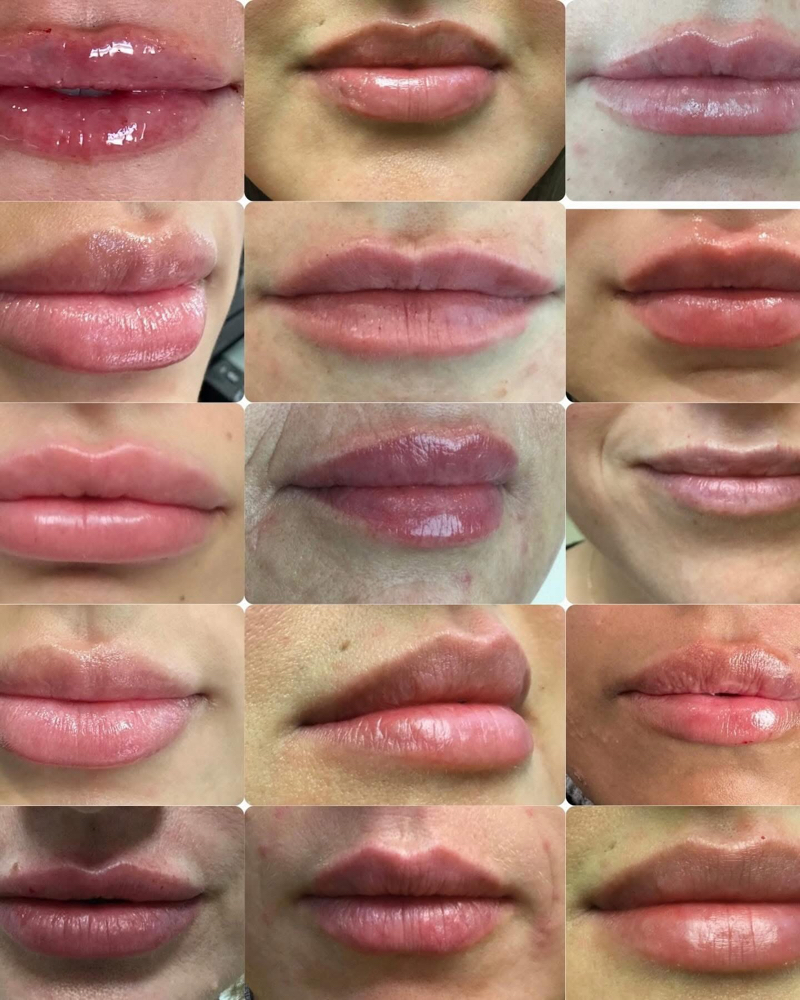 Upper And lower Lip Filler