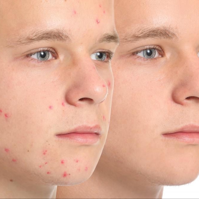 Teen Acne Facial at Kel Bella Aesthetics in Santa Clarita, CA