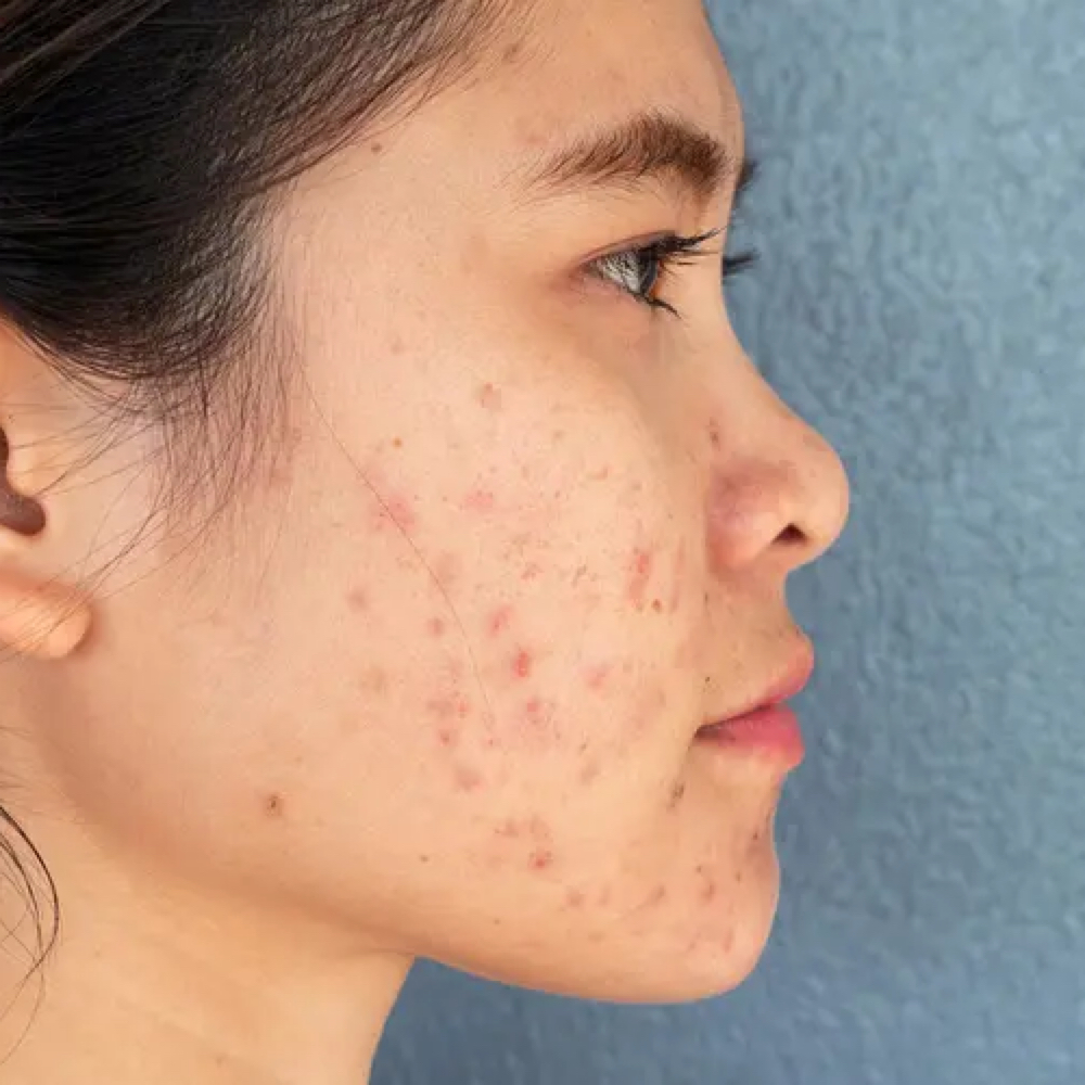 Bye-Bye Blemish at Skin by Cydni in Atlanta, GA