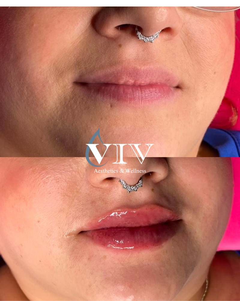 Lip & Facial Fillers at Viv Aesthetics & Wellness in San Antonio, TX