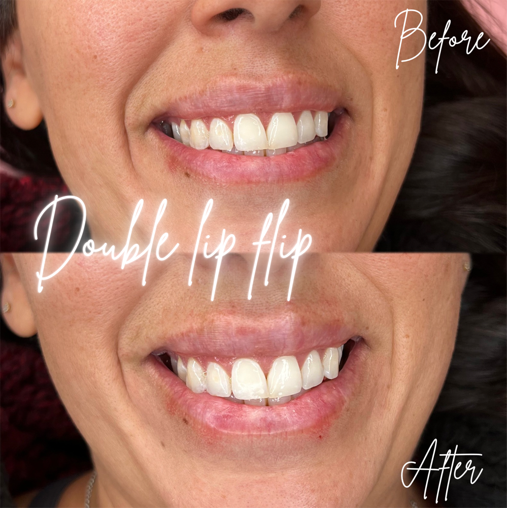 Tox-Double Lip Flip💉 at BeautyHolic Aesthetics LLC in Lubbock, TX