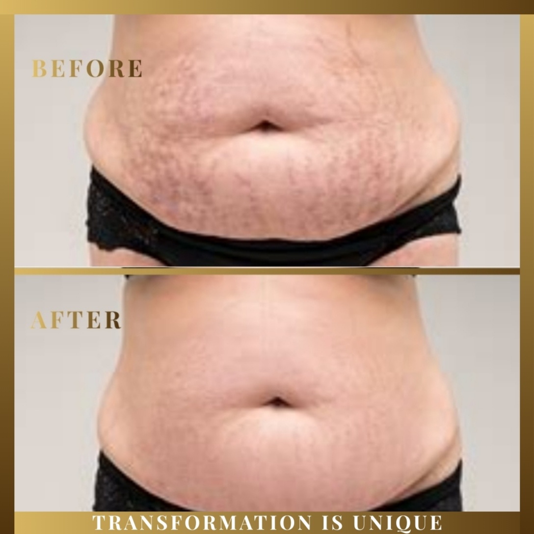 Inkless Stretch Marks Rejuvenation