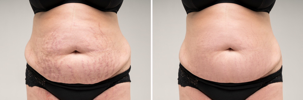 Inkless Stretch Marks Rejuvenation