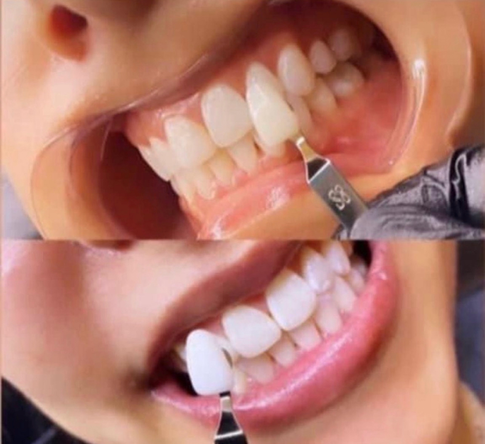 60 Min Teeth Glo Session