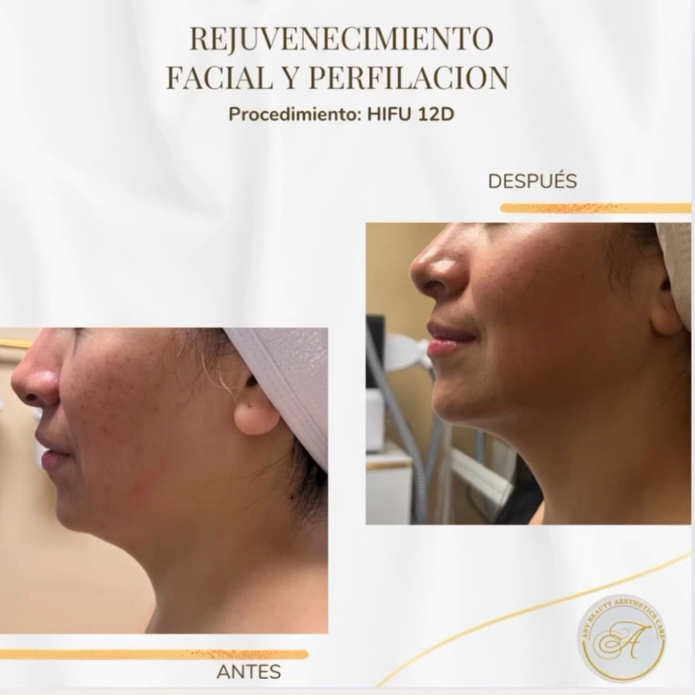 HIFU at Any Beauty Aesthetics Care in New York, NY