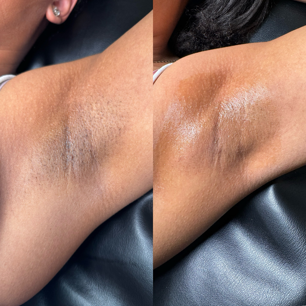 Underarm Lightening