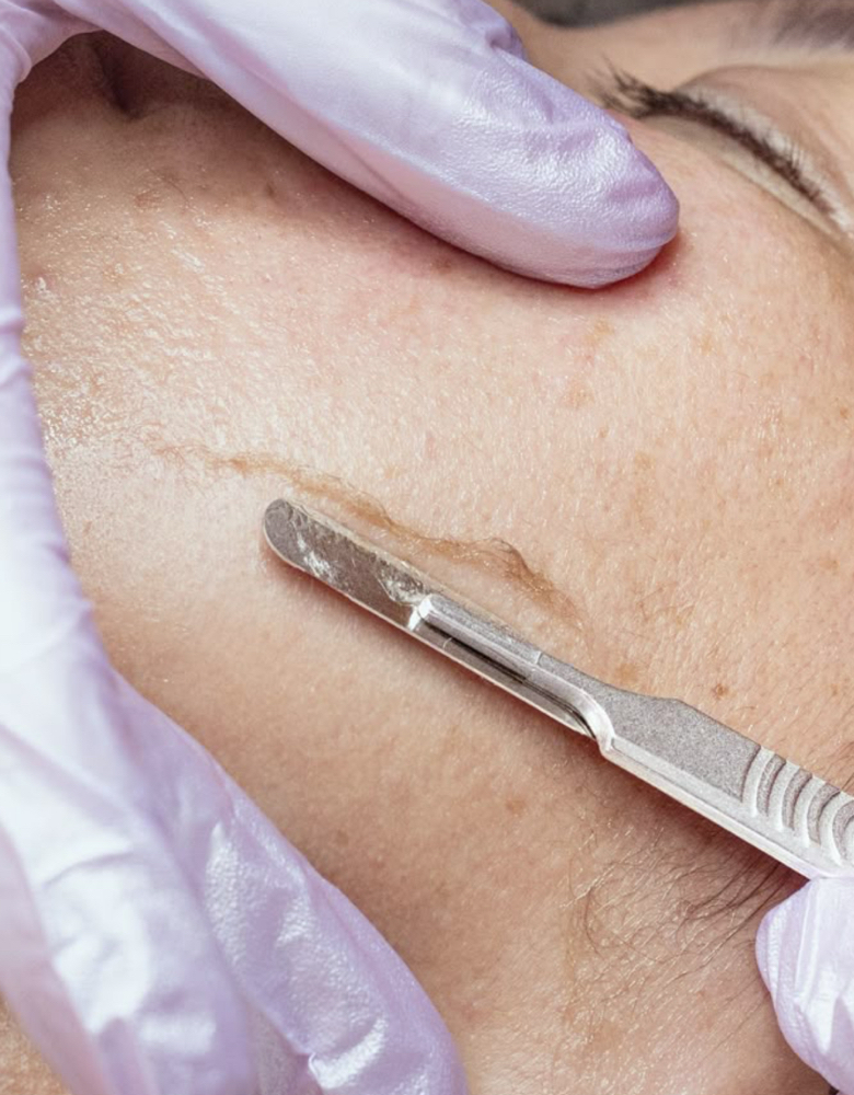 Dermaplane Add On