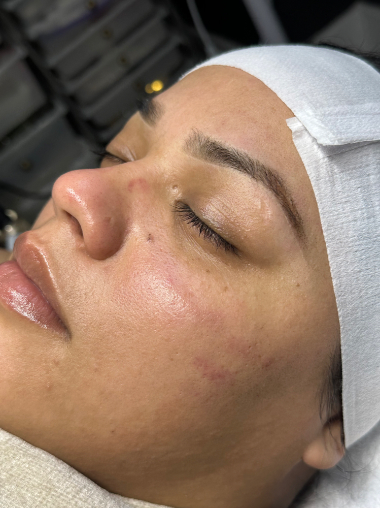 HydraFacial