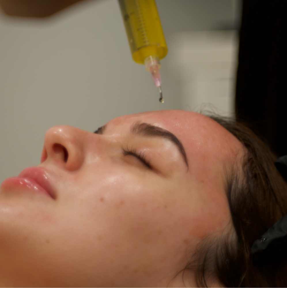 Microneedling with High-Dose PRP at GlowDerm Clinic in San Jose, CA