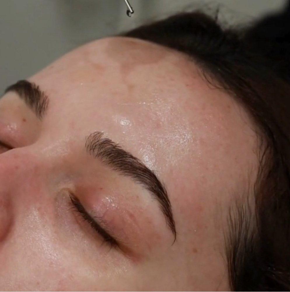 Microneedling with High-Dose PRP at GlowDerm Clinic in San Jose, CA