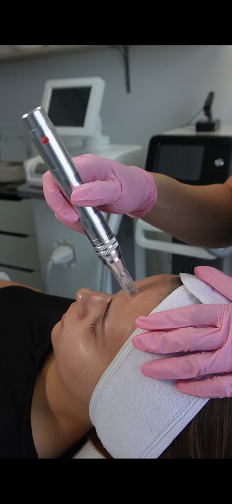 Micro-Needling