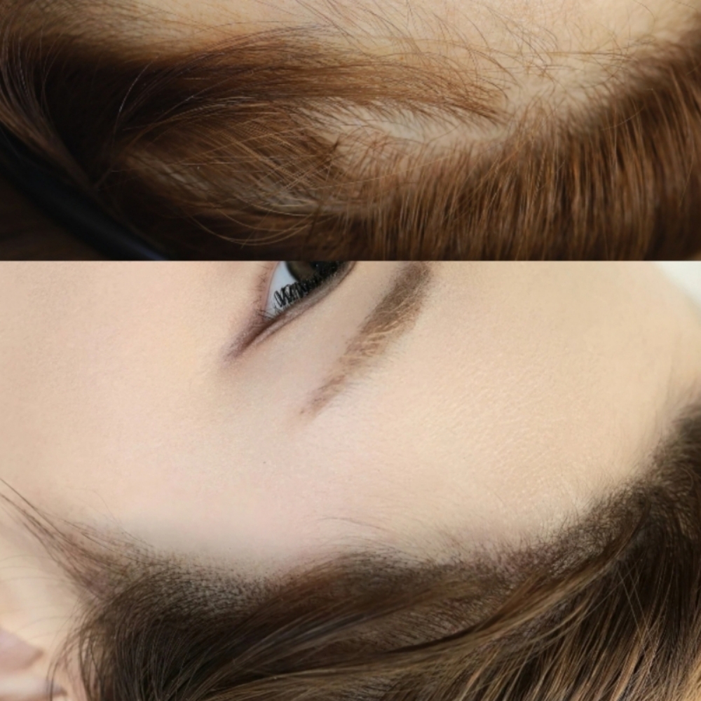 Custom Hairline Reconstruction SMP at VOID SMP in Los Angeles, CA