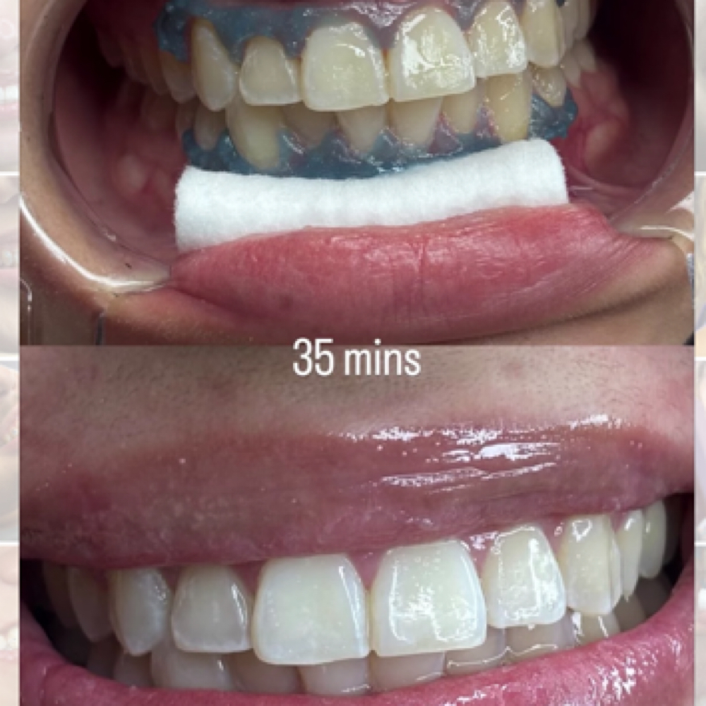 Teeth Whitening - 35 Mins at Alejos Aesthetics in Cleveland, TX