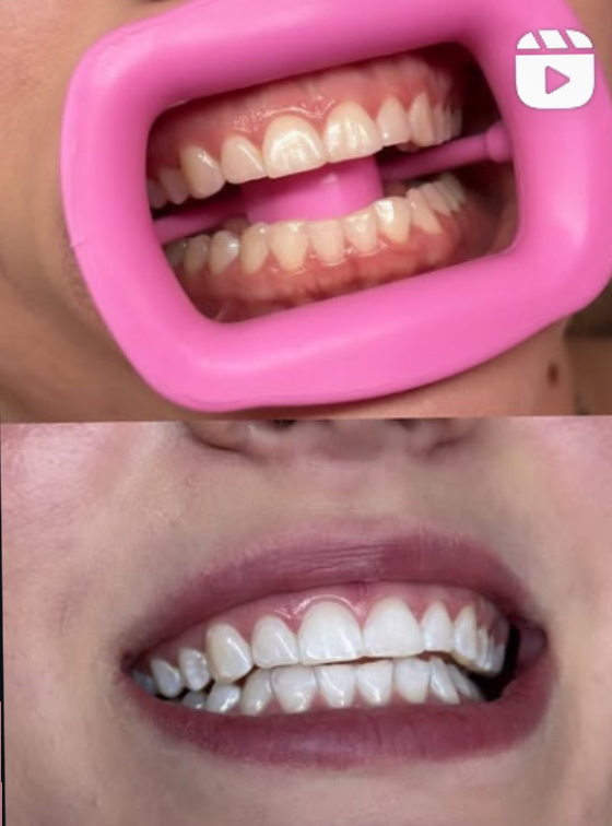 Teeth Whitening - 30 Mins