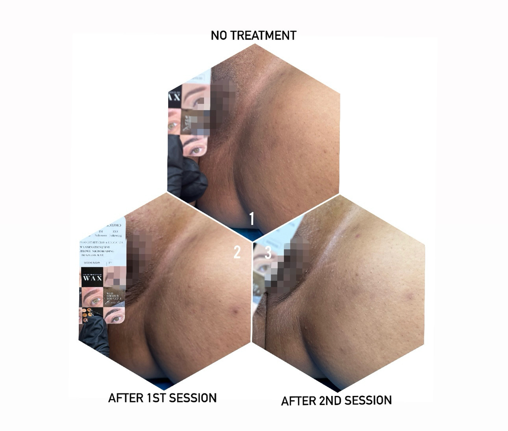 Body & Intimate Brightening