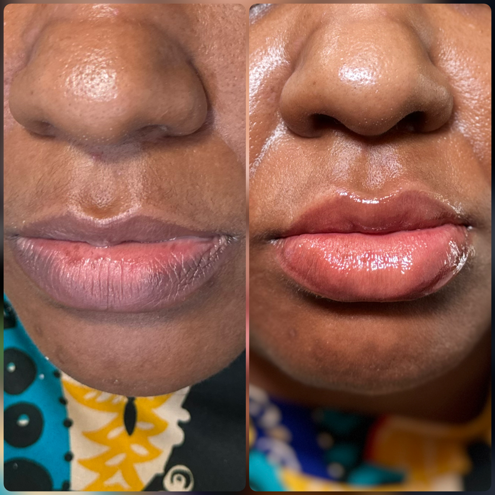 Lip Neutralization