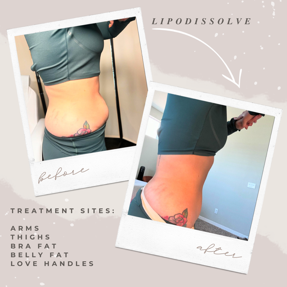 Lipo Dissolve (Fat Dissolver)