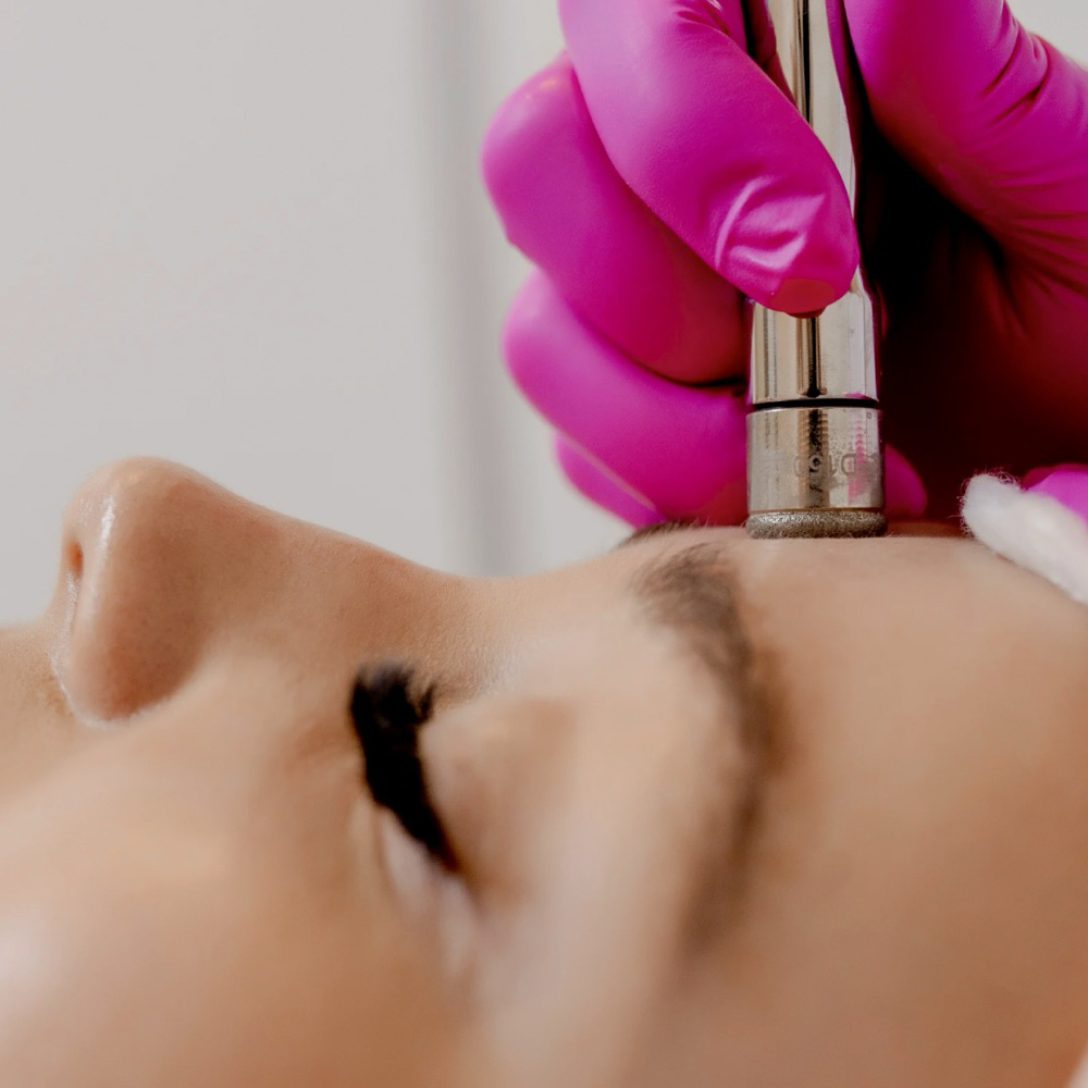 Custom Microdermabrasion Treatment
