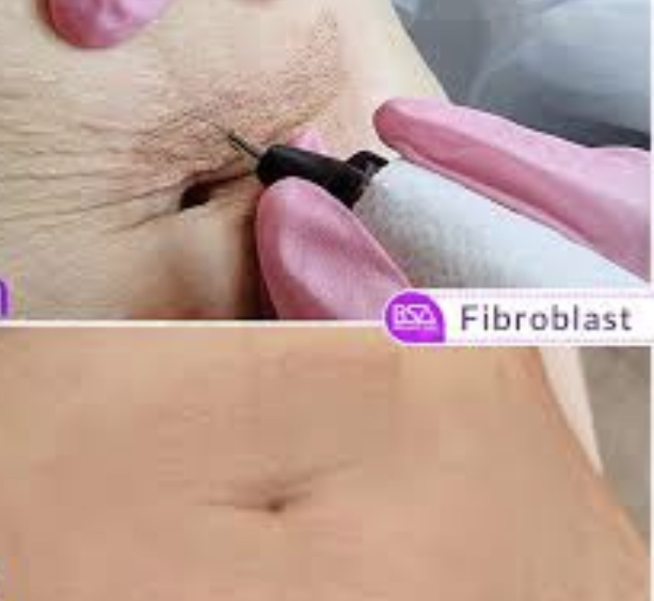 MINI FIBROBLAST TUMMY TUCK