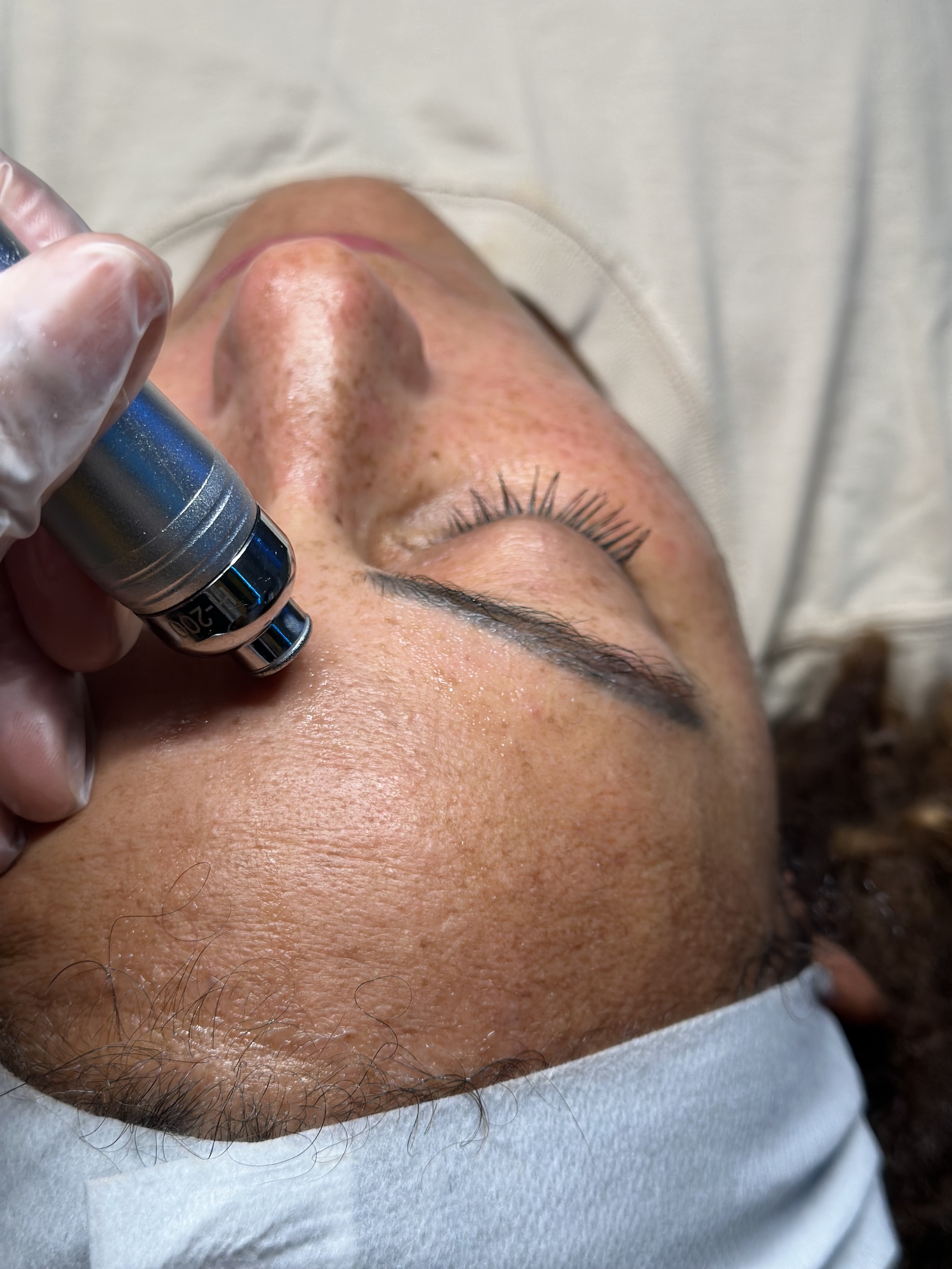 Hydro-Dermabrasion Glow