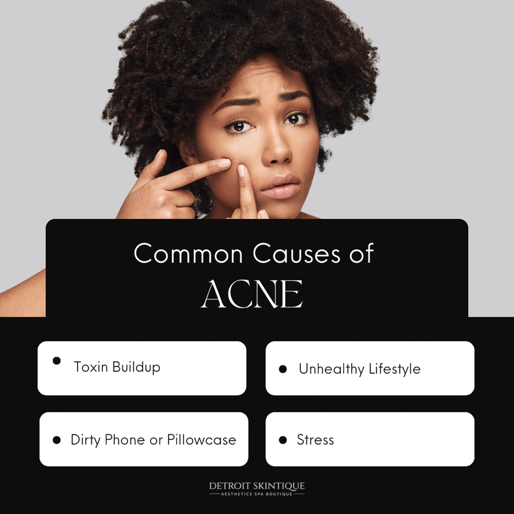 Signature Acne Peel