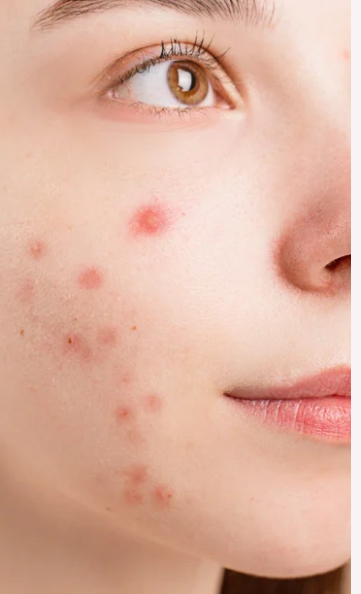 Acne Bootcamp - First Time Client