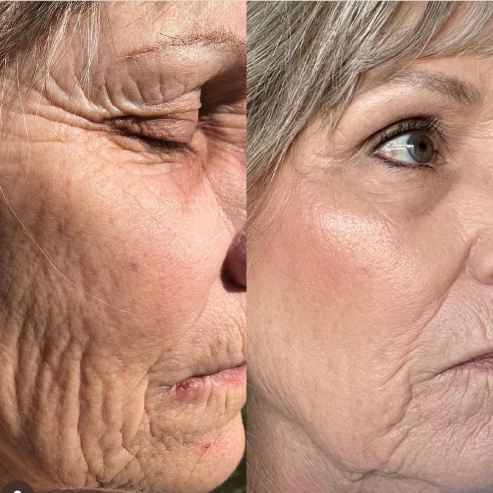 Skin Tightening Full Face