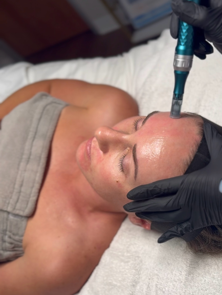 Microneedling With Exosomes at Celestial Aesthetics in College Station, TX