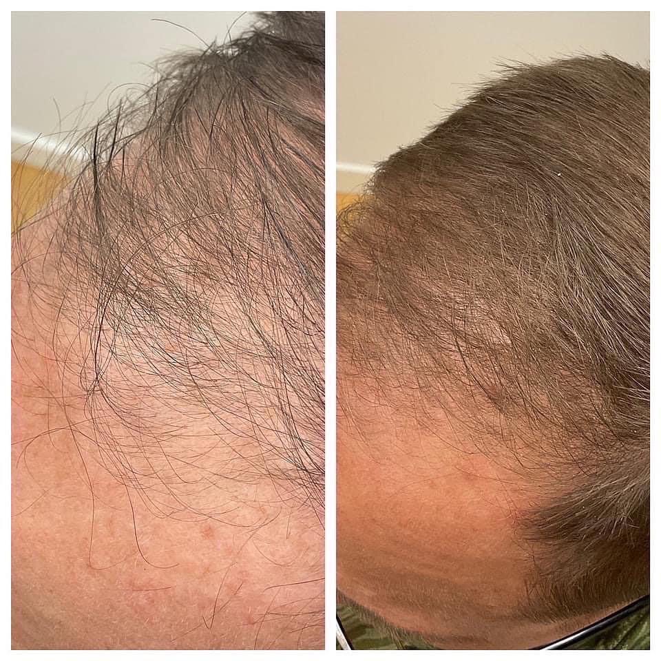Procell Therapies, Hair Restoration